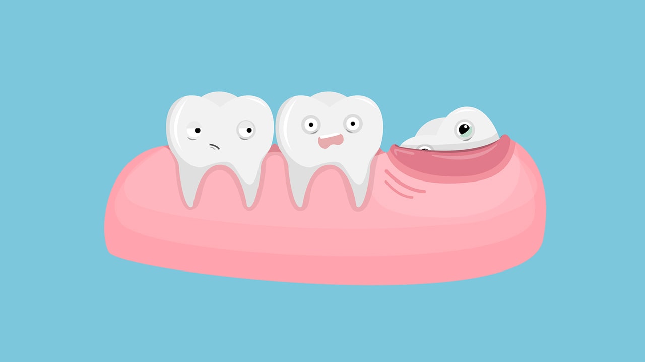 Wisdom Teeth Removal: Top 4 Ways it May Help You.
