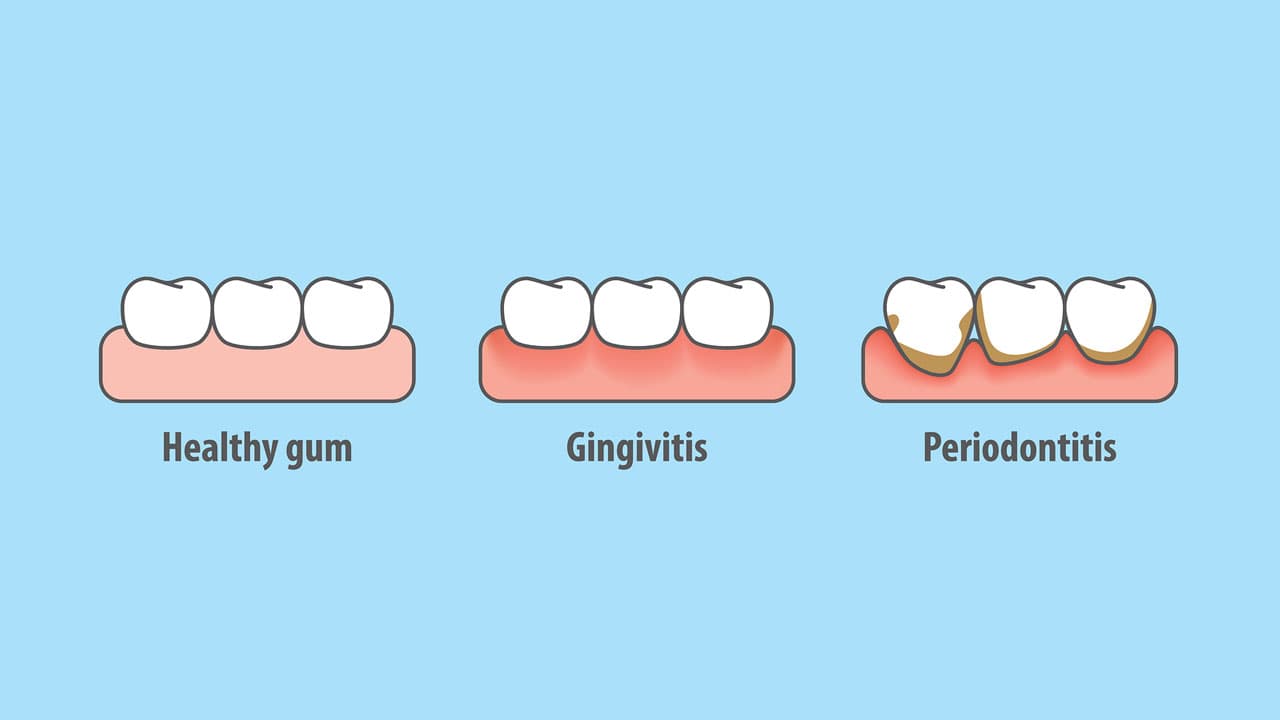 Gum Disease Vernon Hills