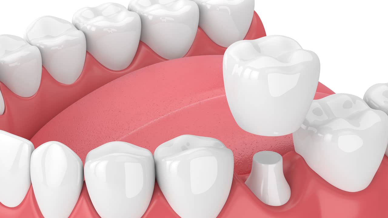 Ceramic dental reconstruction
